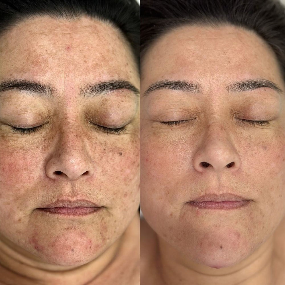 K Microneedling + Exosome + more