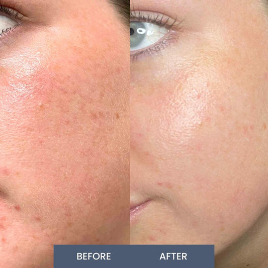 K- Skin Renewal Therapy