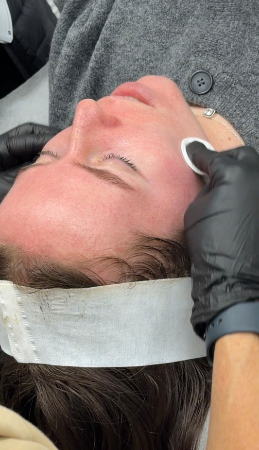 K-Acne Reset Therapy