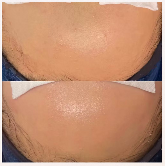 GLASS SKIN FACIAL + LHALA PEEL x 3