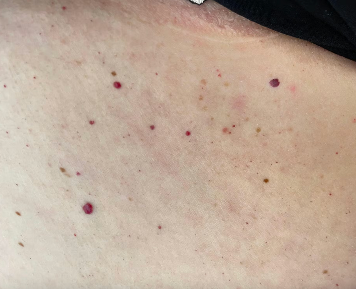 Cherry Angioma Removal