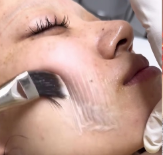 GLASS SKIN FACIAL + LHALA PEEL