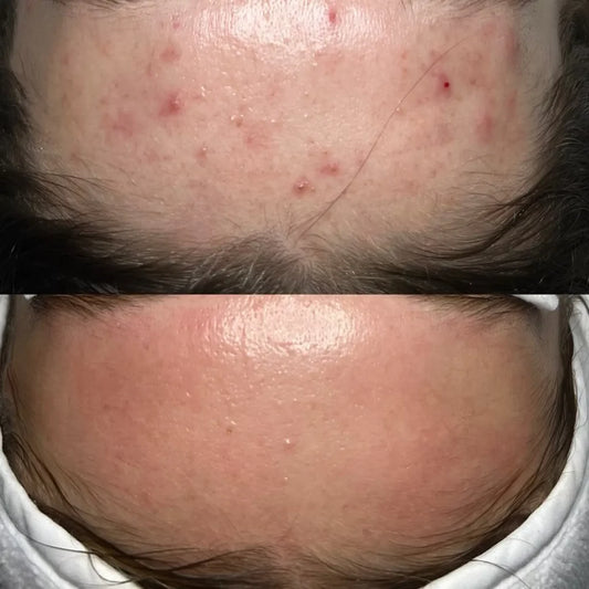 K-Acne Reset Therapy