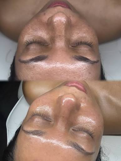 Superjection Retinaroid - Sept Sale