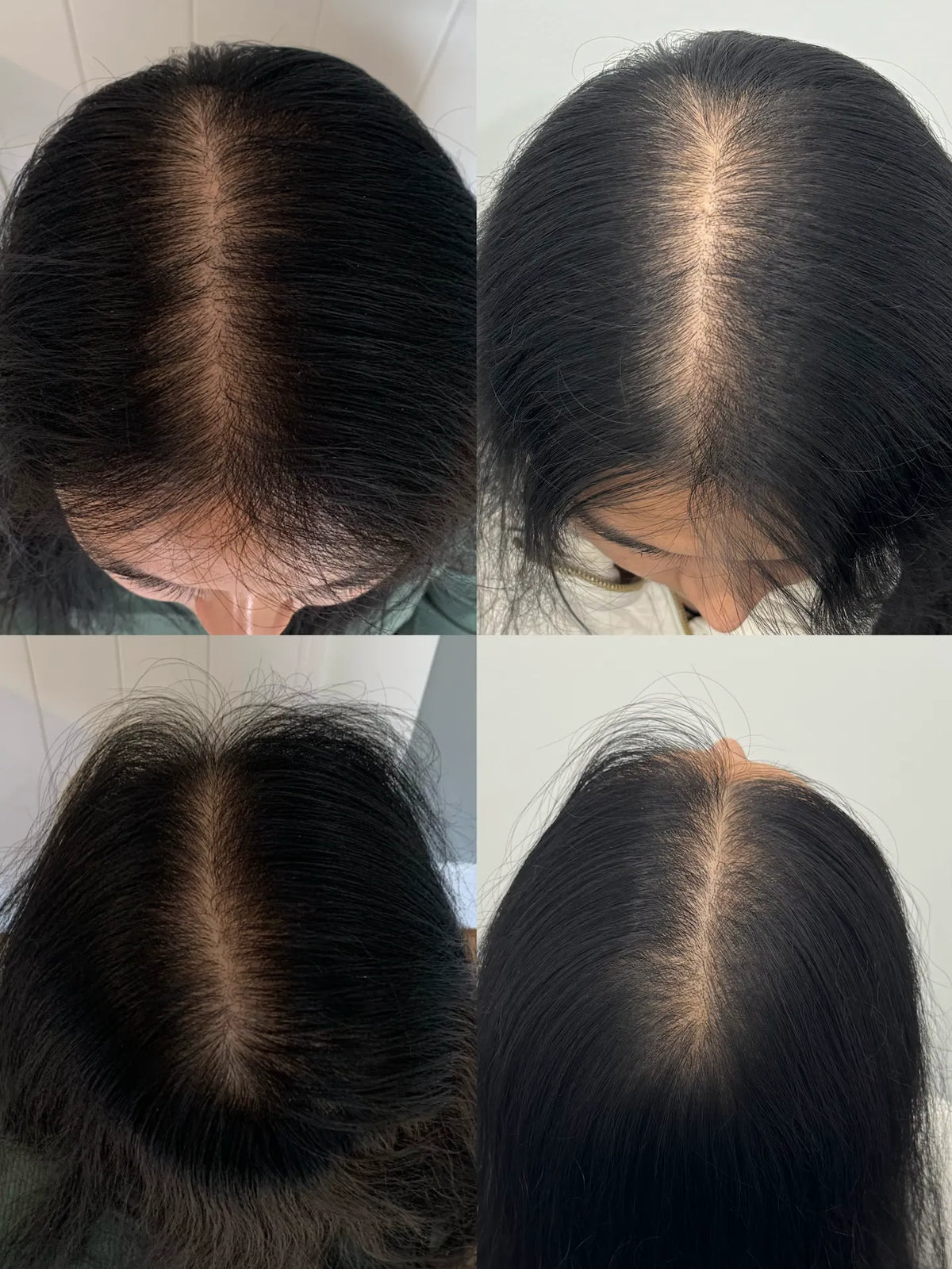 Hair Regrowth Therapy