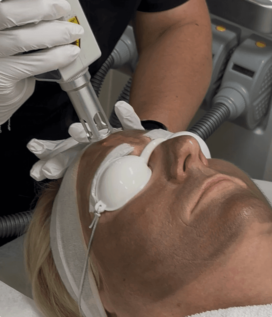 Carbon Laser Peel Treatment