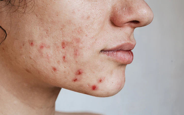 Acne Treatment