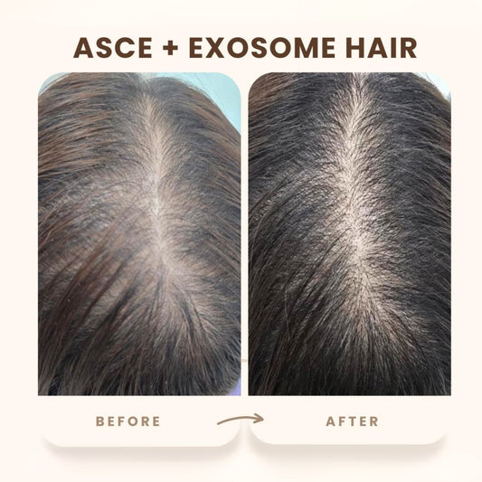 ASCE plus HRLV - Hair Regrowth