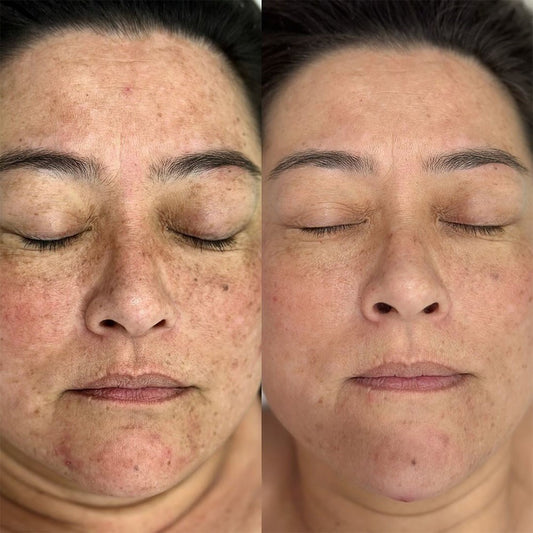 K Microneedling + Exosome + more