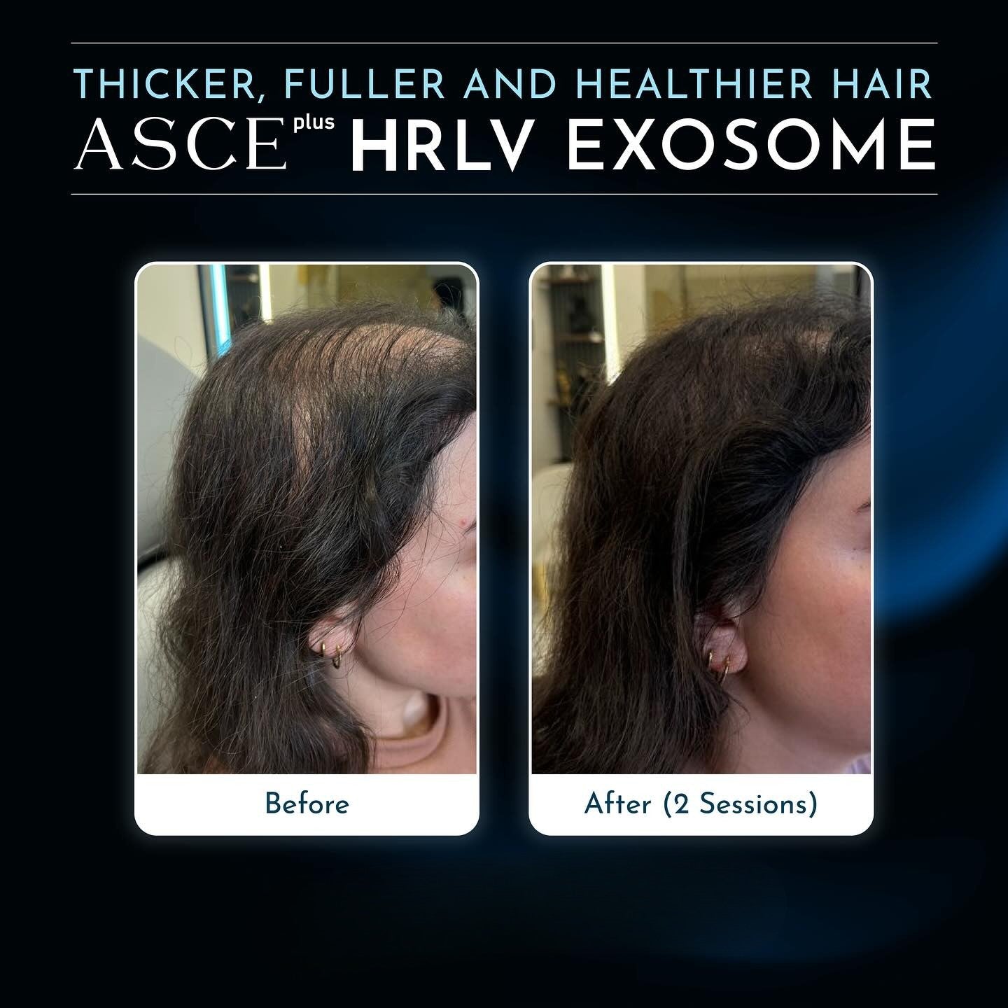 ASCE plus HRLV Treatment X 2