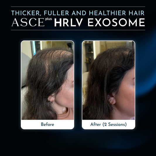 ASCE plus HRLV Treatment X 2