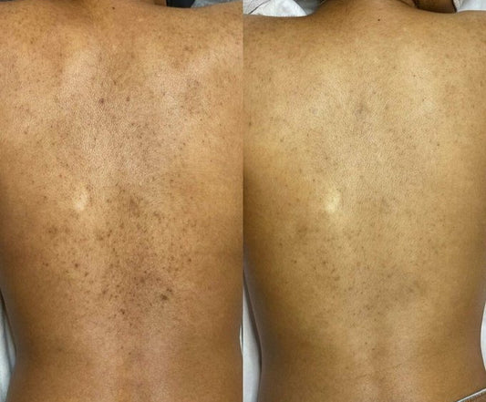 K Microneedling - Half Back