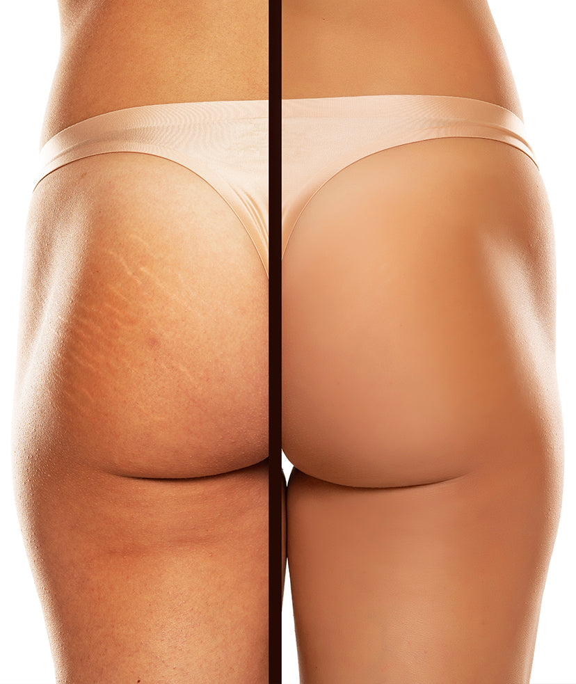 K Microneedling - Butt