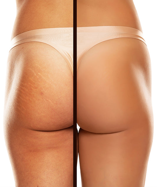 K Microneedling - Butt