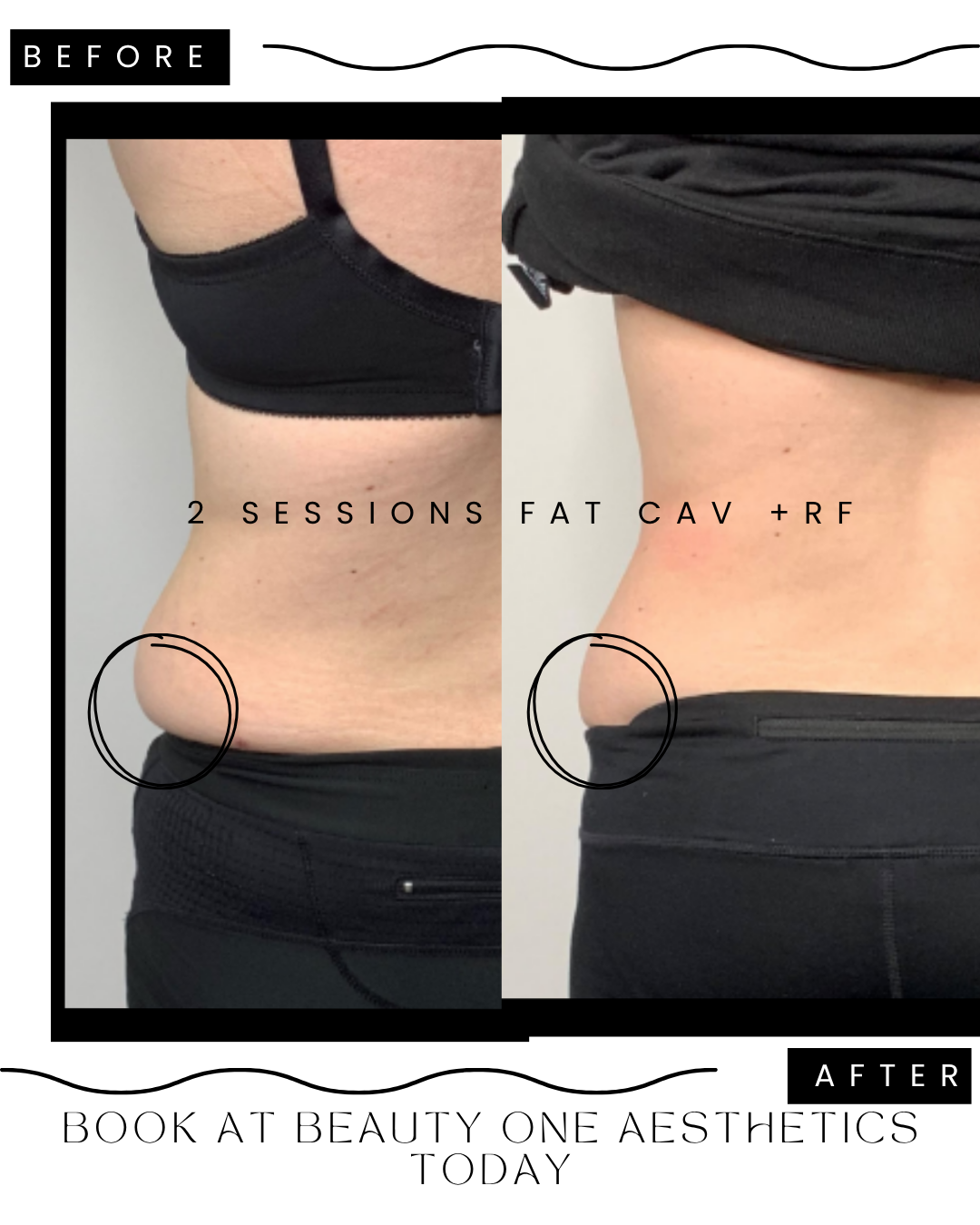 Fat One Fat cavitation – Beauty One Aesthetics