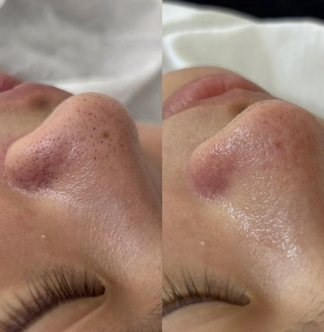 HydraGlow Facial