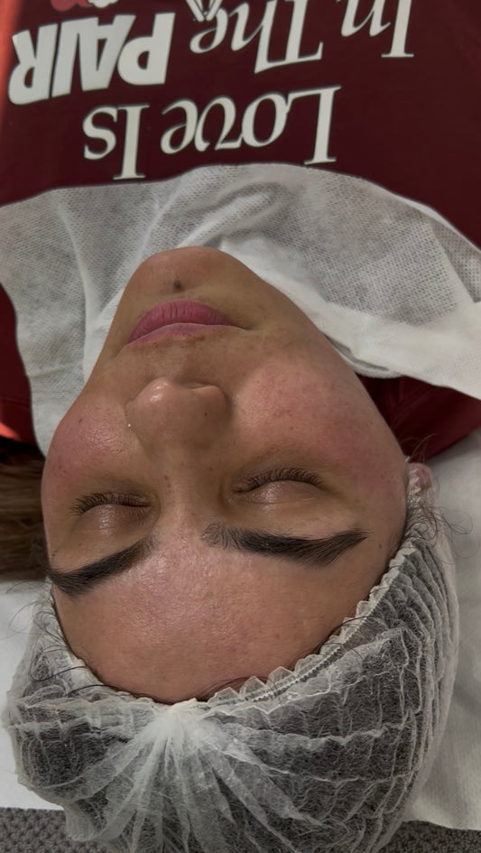 K Microneedling - Face