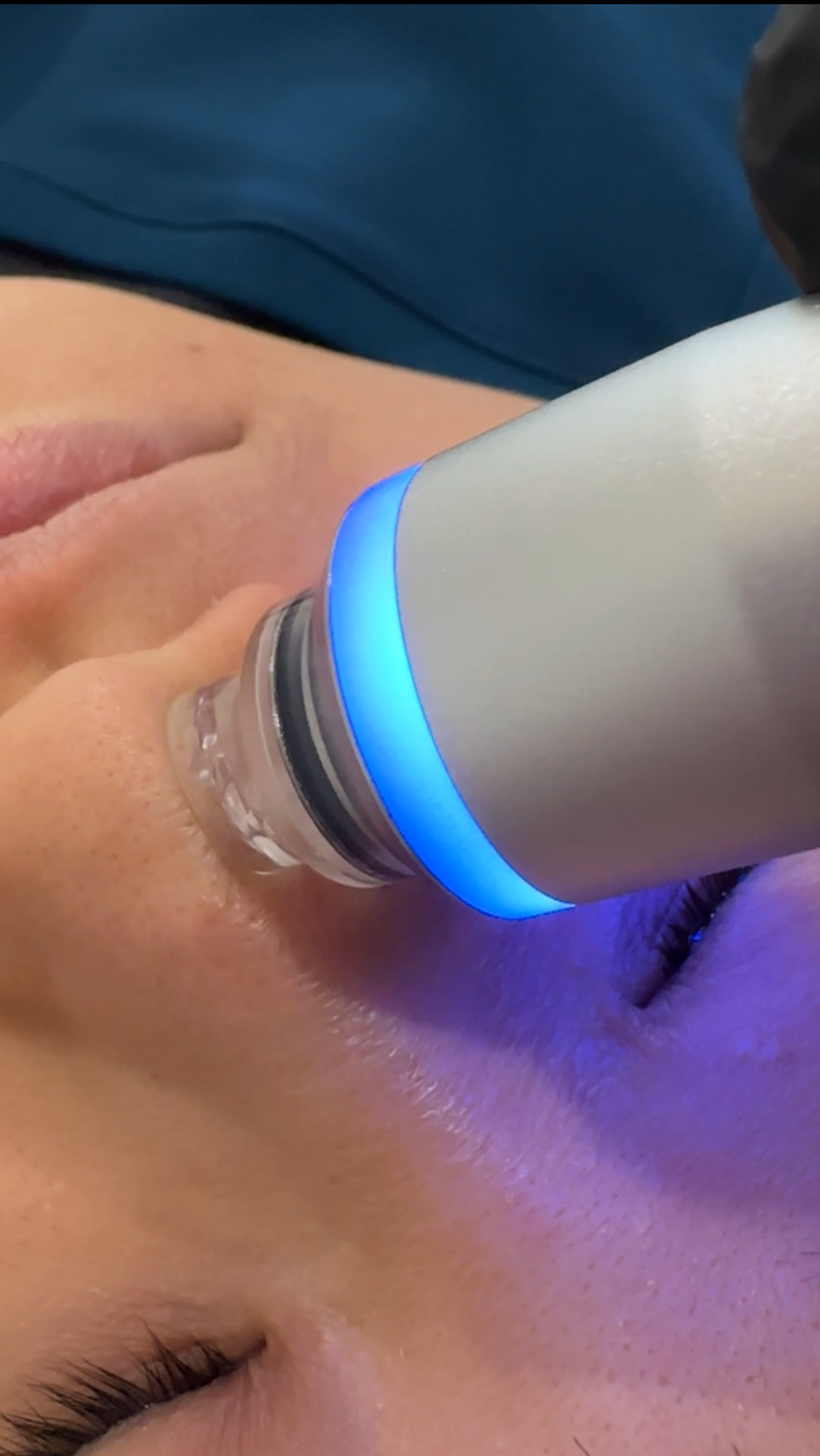 HydraGlow Facial