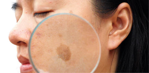 IPL Pigmentation Removal - Face