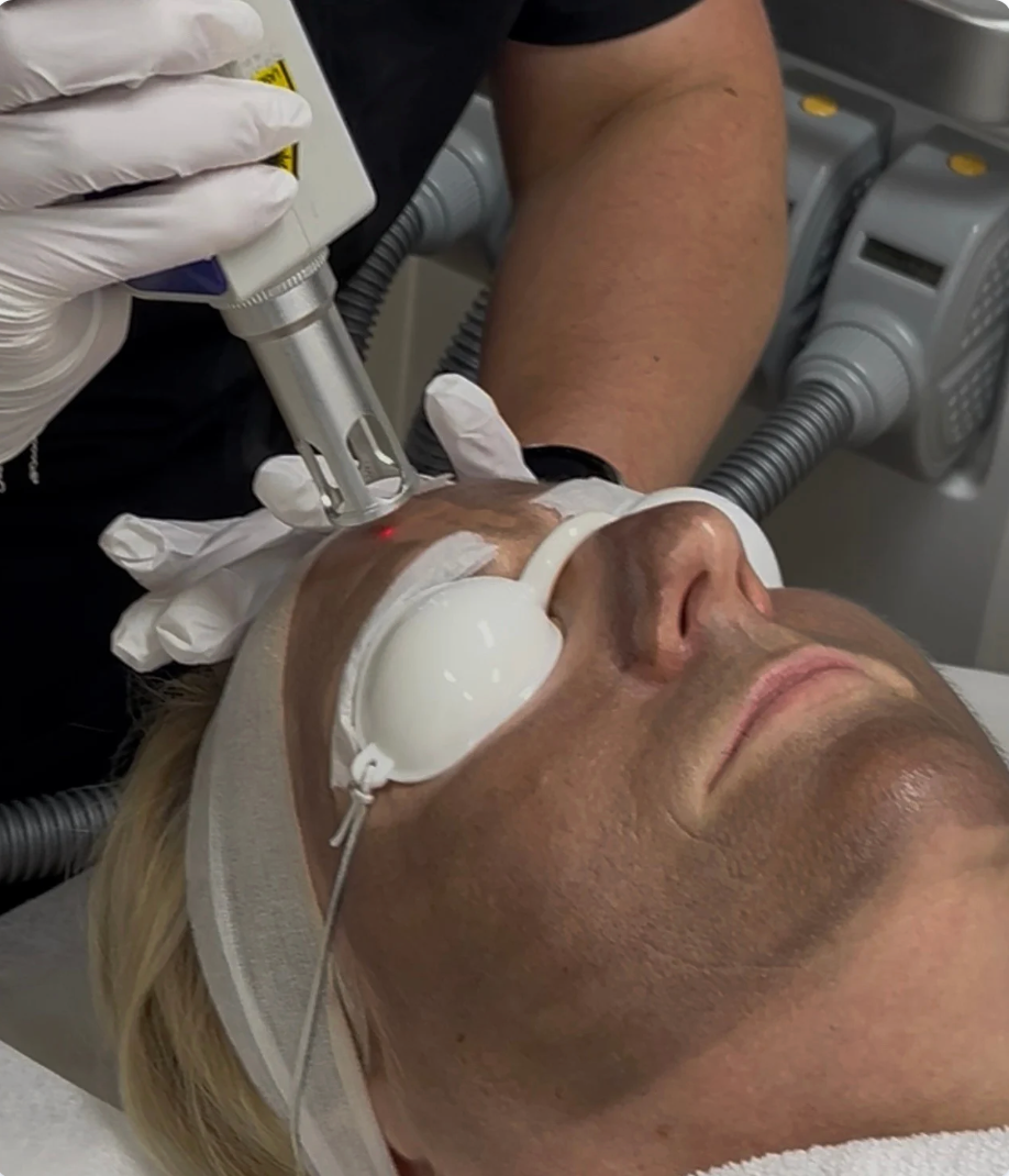 Hollywood Laser Peel Face