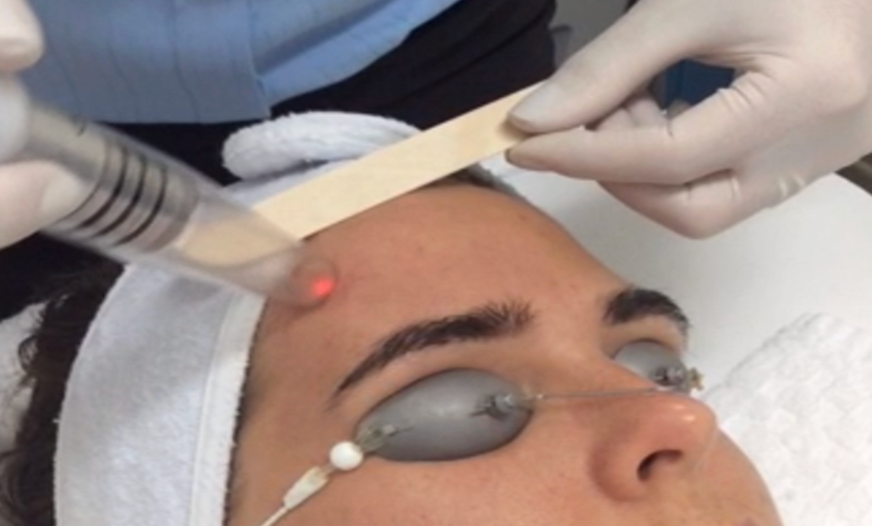 Laser Toning Facial