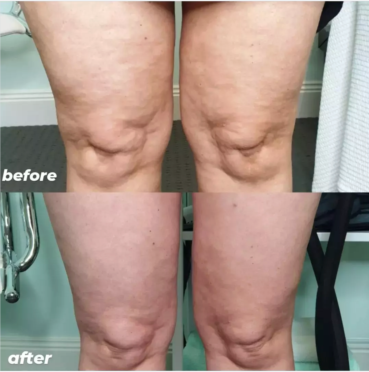 HIFU - Knee