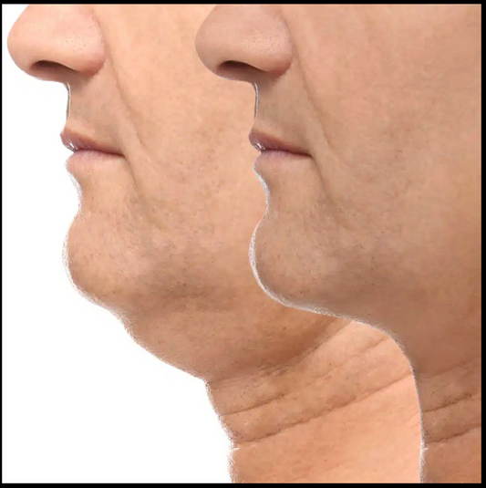 HIFU Double Chin